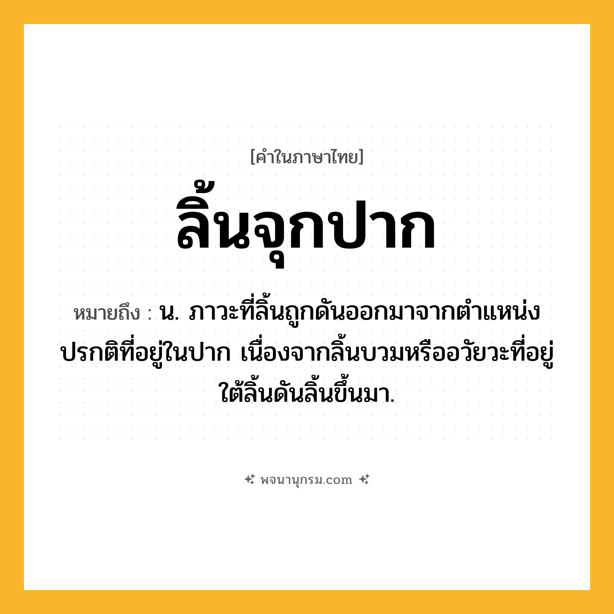 ลิ้นจุกปาก ความหมาย หมายถึงอะไร?, คำในภาษาไทย ลิ้นจุกปาก หมายถึง น. ภาวะที่ลิ้นถูกดันออกมาจากตำแหน่งปรกติที่อยู่ในปาก เนื่องจากลิ้นบวมหรืออวัยวะที่อยู่ใต้ลิ้นดันลิ้นขึ้นมา.
